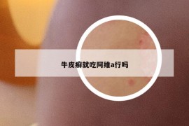 牛皮癣就吃阿维a行吗