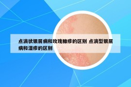 点滴状银屑病和玫瑰糠疹的区别 点滴型银屑病和湿疹的区别