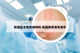 新疆适合银屑病待吗 新疆银屑病发病率