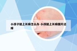 小孩子腿上长癣怎么办 小孩腿上长癣图片还痒