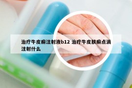 治疗牛皮癣注射液b12 治疗牛皮肤癣点滴注射什么