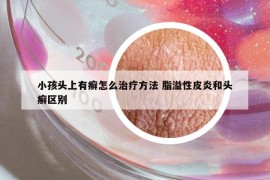 小孩头上有癣怎么治疗方法 脂溢性皮炎和头癣区别