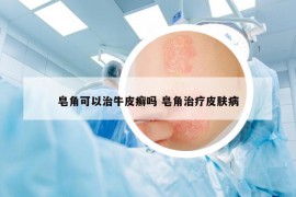 皂角可以治牛皮癣吗 皂角治疗皮肤病