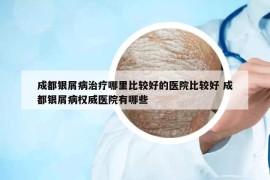 成都银屑病治疗哪里比较好的医院比较好 成都银屑病权威医院有哪些