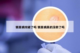 银屑病攻破了吗 银屑病真的没救了吗