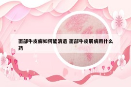 面部牛皮癣如何能消退 面部牛皮屑病用什么药