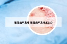 银屑病不发痒 银屑病不发痒怎么办