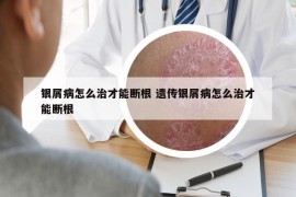 银屑病怎么治才能断根 遗传银屑病怎么治才能断根