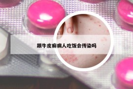 跟牛皮癣病人吃饭会传染吗