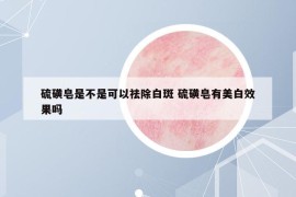 硫磺皂是不是可以祛除白斑 硫磺皂有美白效果吗