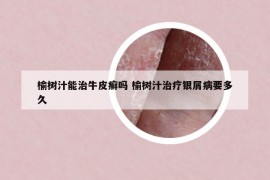 榆树汁能治牛皮癣吗 榆树汁治疗银屑病要多久