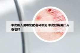 牛皮癣人用哪些肥皂可以洗 牛皮肤癣用什么香皂好