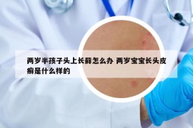 两岁半孩子头上长藓怎么办 两岁宝宝长头皮癣是什么样的