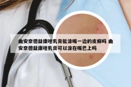 曲安奈德益康唑乳膏能涂嘴一边的皮癣吗 曲安奈德益康唑乳膏可以涂在嘴巴上吗