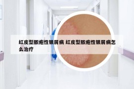 红皮型脓疱性银屑病 红皮型脓疱性银屑病怎么治疗