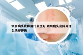 银屑病头皮痒用什么洗好 银屑病头皮痒用什么洗好得快