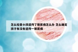 怎么检查小孩遗传了银屑病怎么办 怎么确定孩子有没有遗传一银屑病