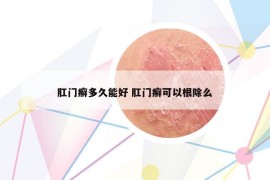 肛门癣多久能好 肛门癣可以根除么