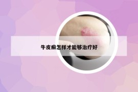 牛皮癣怎样才能够治疗好