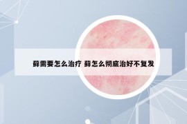 藓需要怎么治疗 藓怎么彻底治好不复发