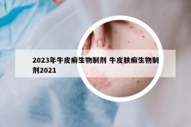 2023年牛皮癣生物制剂 牛皮肤癣生物制剂2021