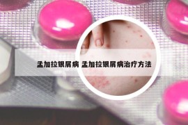 孟加拉银屑病 孟加拉银屑病治疗方法