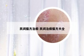 民间偏方治癣 民间治癣偏方大全