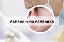 头上长皮癣用什么药膏 头皮长癣擦什么药