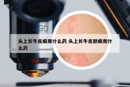 头上长牛皮癣用什么药 头上长牛皮肤癣用什么药