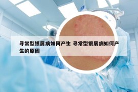 寻常型银屑病如何产生 寻常型银屑病如何产生的原因