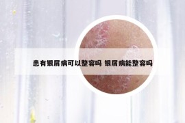 患有银屑病可以整容吗 银屑病能整容吗