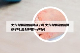 女方有银屑病能要孩子吗 女方有银屑病能要孩子吗,是否影响怀孕时间