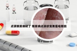 点滴银屑病硬了 银屑病点滴状变黑是啥原因