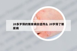 20多岁得的银屑病会遗传么 20岁得了银屑病