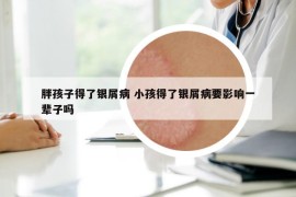 胖孩子得了银屑病 小孩得了银屑病要影响一辈子吗