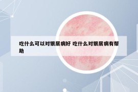 吃什么可以对银屑病好 吃什么对银屑病有帮助