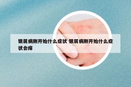 银屑病刚开始什么症状 银屑病刚开始什么症状会痒