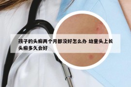 孩子的头癣两个月都没好怎么办 幼童头上长头癣多久会好