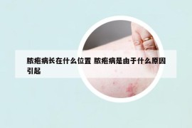 脓疱病长在什么位置 脓疱病是由于什么原因引起