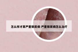 怎么样才算严重银屑病 严重银屑病怎么治疗