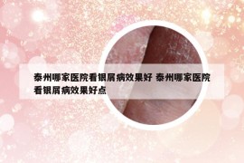 泰州哪家医院看银屑病效果好 泰州哪家医院看银屑病效果好点