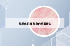 红颜色的癣 红色的癣是什么