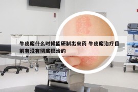 牛皮廨什么时候能研制出来药 牛皮廨治疗目前有没有彻底根治的