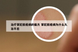 治疗掌跎脓疱病的偏方 掌跎脓疱病为什么久治不愈