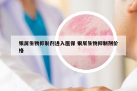 银屑生物抑制剂进入医保 银屑生物抑制剂价格