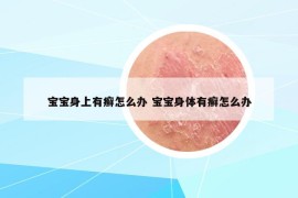 宝宝身上有癣怎么办 宝宝身体有癣怎么办