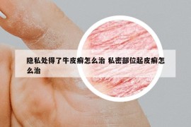 隐私处得了牛皮癣怎么治 私密部位起皮癣怎么治