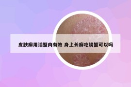 皮肤癣用活蟹肉有效 身上长癣吃螃蟹可以吗