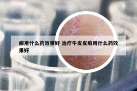 癣用什么药效果好 治疗牛皮皮癣用什么药效果好