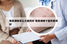 银屑病哪家公立医院好 银屑病哪个医院看得好